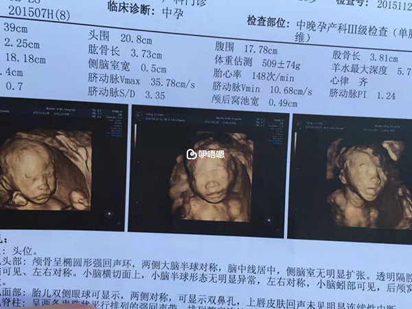 b超檢查單上有字母y代表懷女孩