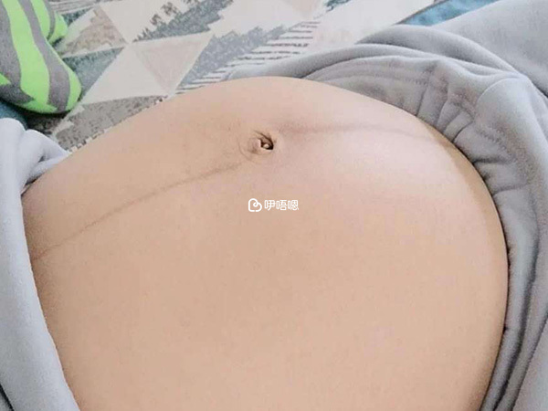 妊娠線又直又細可能懷男孩