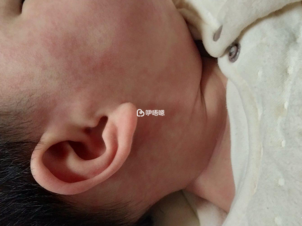 幼兒急疹飲食上有禁忌