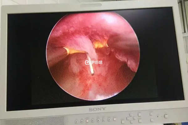 試管移植前做宮腔鏡檢查原因