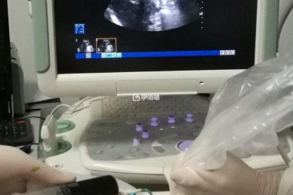 羊水穿刺會刺激到胎兒